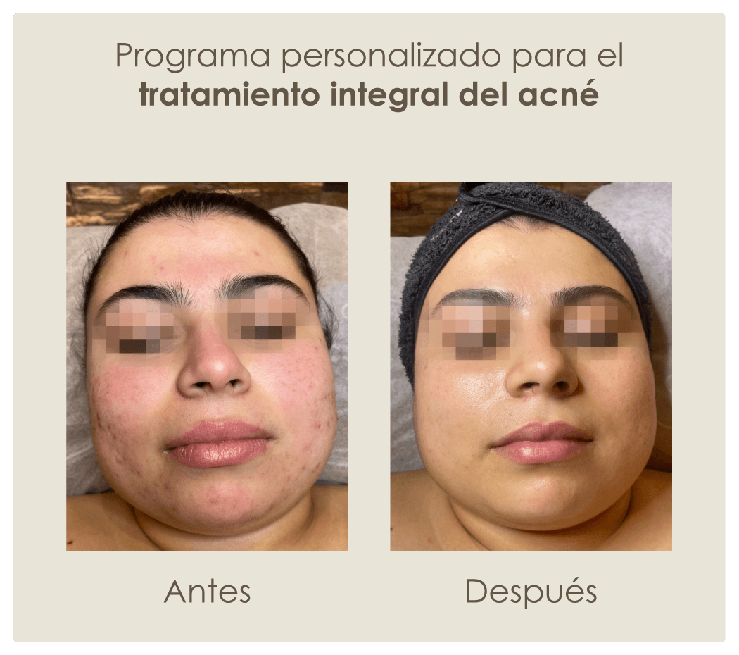 Tratamiento-integral-de-acné