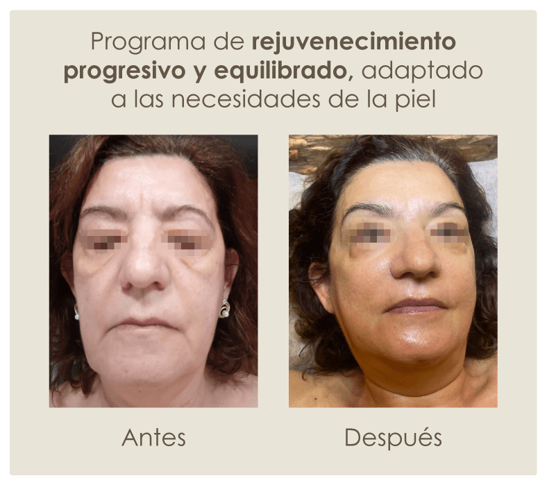 rejuvenecimiento-progresivo-y-equilibrado
