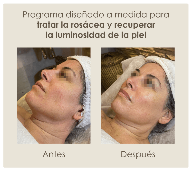 tratar-la-rosácea-y-recuperar-la-luminosidad-de-la-piel